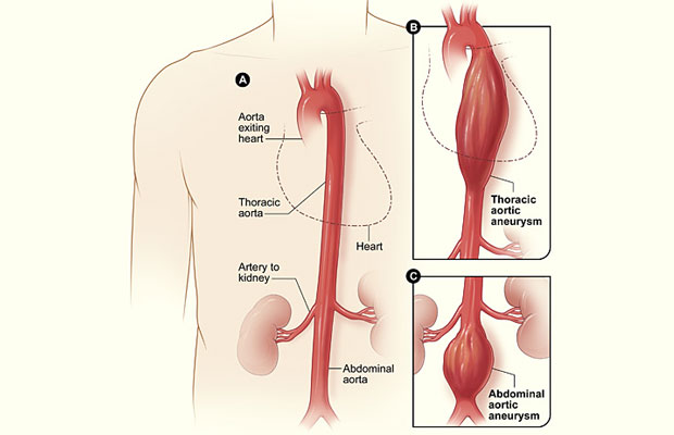 Aortic Aneurysm & Aortic Dissection Surgery in Thane: Recognising the Emergency
